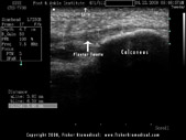 Plantar Fascia Annotated